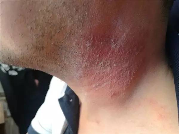 隐翅虫拍死要不要洗,隐翅虫被拍死后用什么药