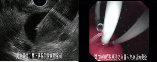 超声内镜检查是什么意思,超声内镜一般多少钱