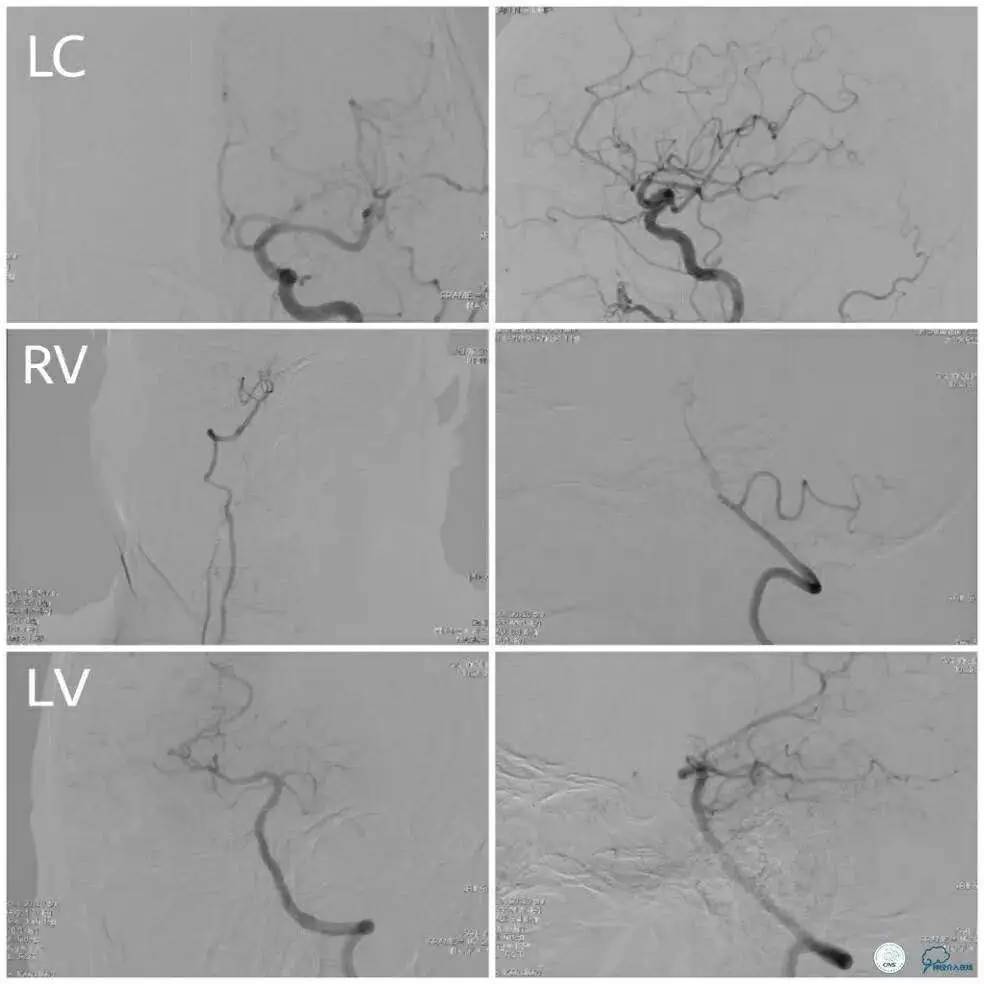 右侧大脑后动脉p1段狭窄支架手术,天坛周记