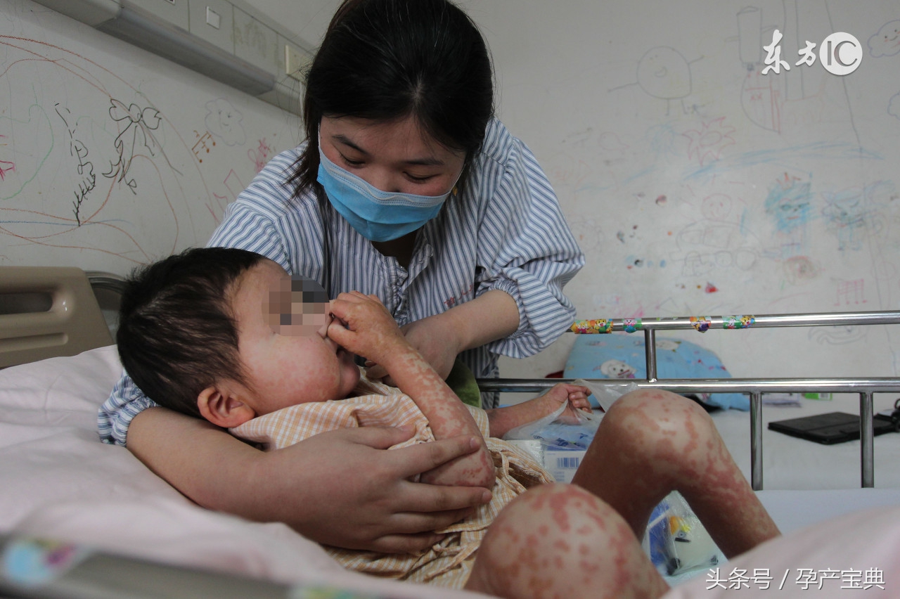 新生婴儿有黄疸又有湿疹怎么办,新生儿湿疹与黄疸有关系吗