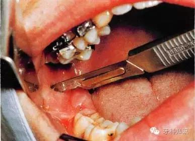 口腔拔牙图片,口腔拔牙麻醉多久消退