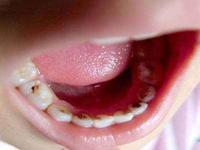 地包天是啥意思有什么不好吗,地包天到底是什么