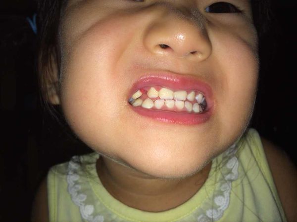 小孩牙齿地包天的原因,牙齿地包天是什么原因造成的