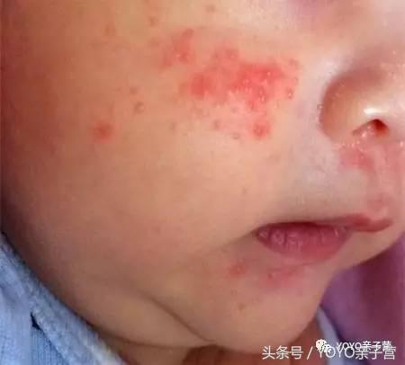 在树宝N次湿疹之后，我总结了这份战“痘”清单送给新手妈妈