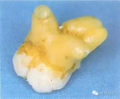 口腔拔牙图片,口腔拔牙麻醉多久消退