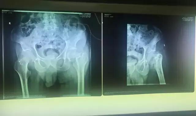 老人胯骨骨折建议手术吗,老人大胯骨折最佳手术时间