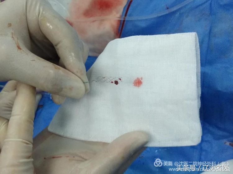 老人脑梗昏迷、大小便*禁失**，医生用这招救回一命！