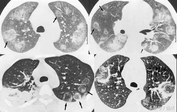 肺里长出小球球,不是吞进去的,而是真菌寄生在里面形成的,严重时可导致大出血