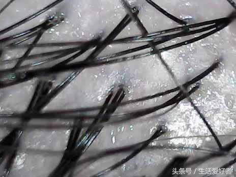 毛囊死了怎么生发,如何判断毛囊是否死亡
