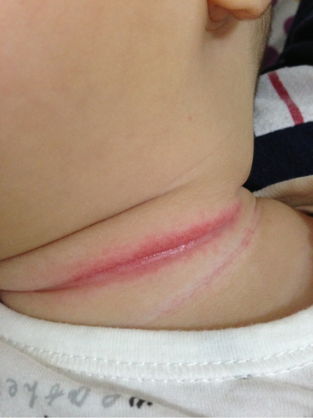 宝宝夏天淹脖子用什么好,夏季宝宝淹脖子怎么办