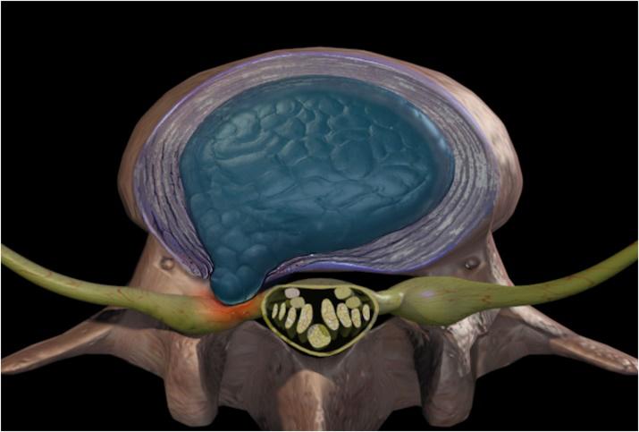 腰椎间盘突出能够完全治好吗,腰椎间盘突出能够治疗吗