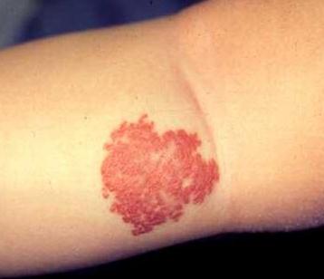 胎记表面粗糙像结痂,胎记表面有小疙瘩