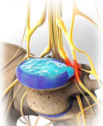 腰椎间盘突出能够压迫胳膊神经吗,腰椎间盘突出能够完全康复吗