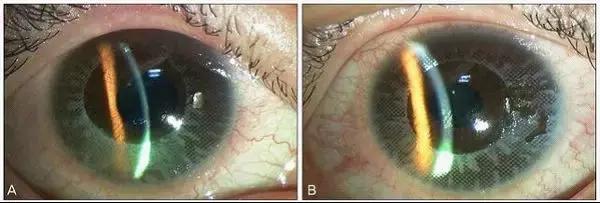 隐形眼镜必知常识,隐形眼镜的6个关键词