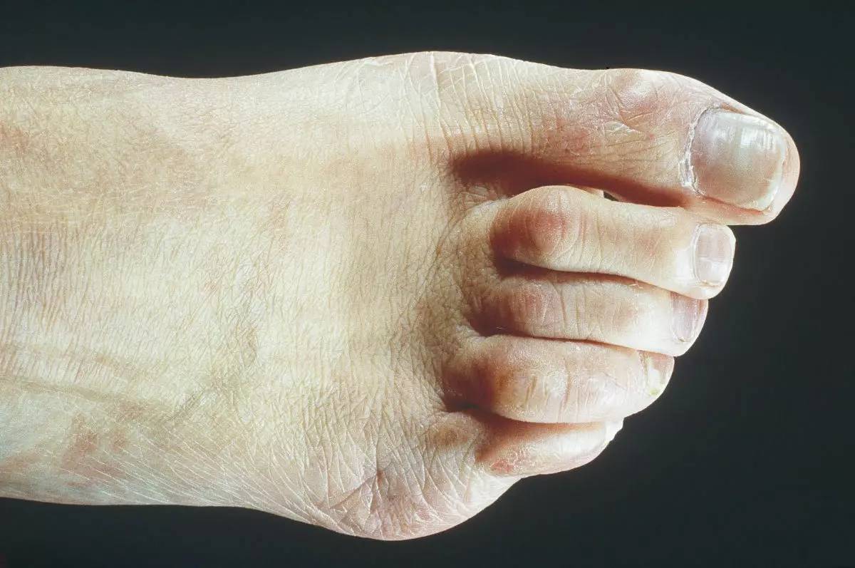 鞋子短顶脚怎么办,鞋子顶大脚趾疼怎么办