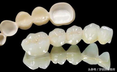美学补牙和普通补牙区别,除了树脂补牙还有什么材料补牙