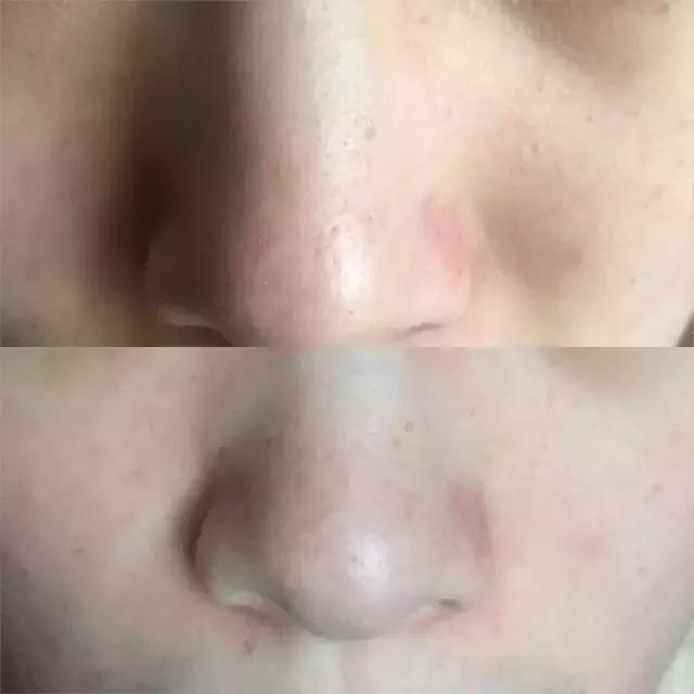 猪鼻贴去黑头,泰国进口去黑头鼻贴