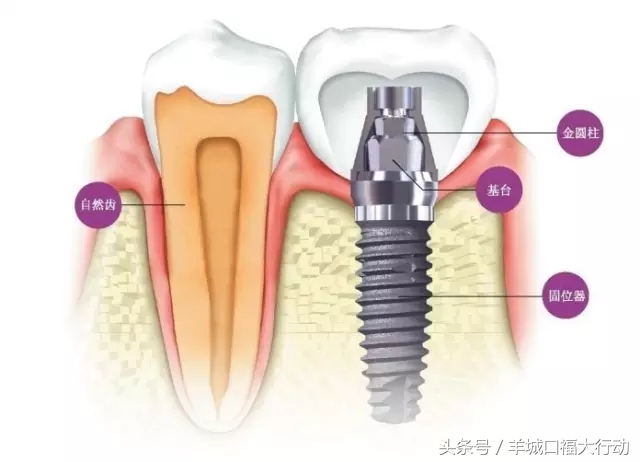 种植牙的八大优势你知道吗,种植牙的优势动画视频