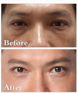 切除眼袋是唯一解决眼袋的方法,眼袋切除方法有哪些