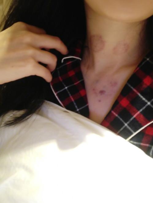 杨幂放血治感冒吗,神奇的中医辨证治疗