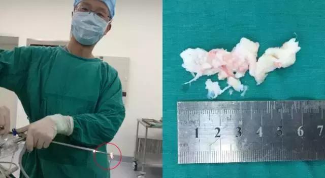 《1039生活馆》之“健康导医”：腰突手术如何不再“伤筋动骨”？