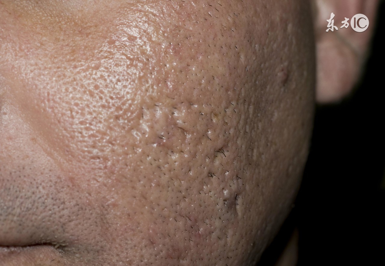 “闭口粉刺”让人不忍直视！关于“粉刺”不得不说的秘密~