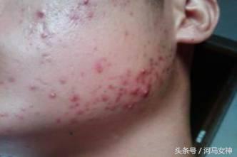 抗痘填坑,抗痘期间忌口大全