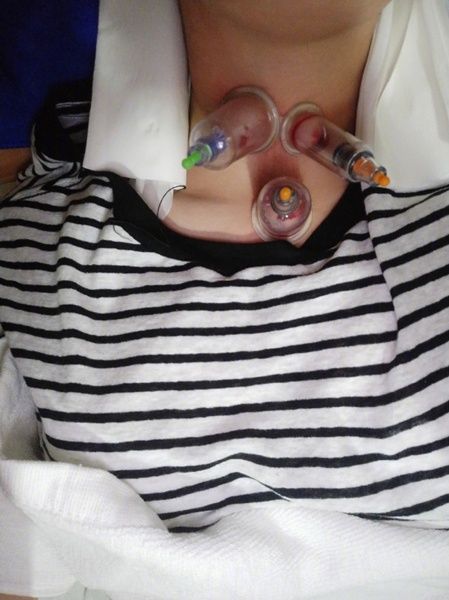 杨幂感冒发烧,杨幂针灸放血治疗