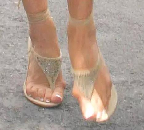 贝克汉姆的脚变形,贝克汉姆老婆脚外翻