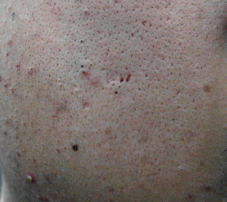 毛孔粗大收缩毛孔最有效的土方法,毛孔粗大怎么办教你快速收缩毛孔