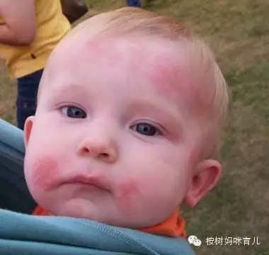 宝宝湿疹咋办能抹风油精吗,宝宝湿疹拿什么药泡澡