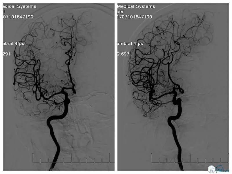 右侧大脑后动脉p1段狭窄支架手术,天坛周记
