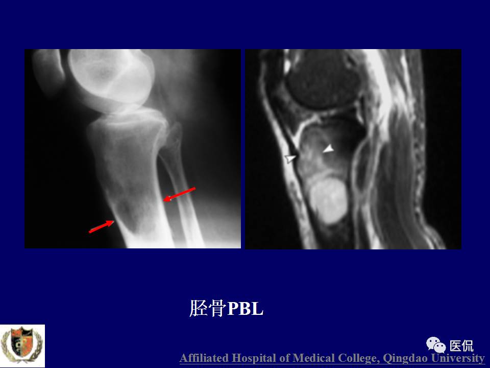 徐文坚老师精讲：原发性骨淋巴瘤影像学诊断医学影像精品PPT