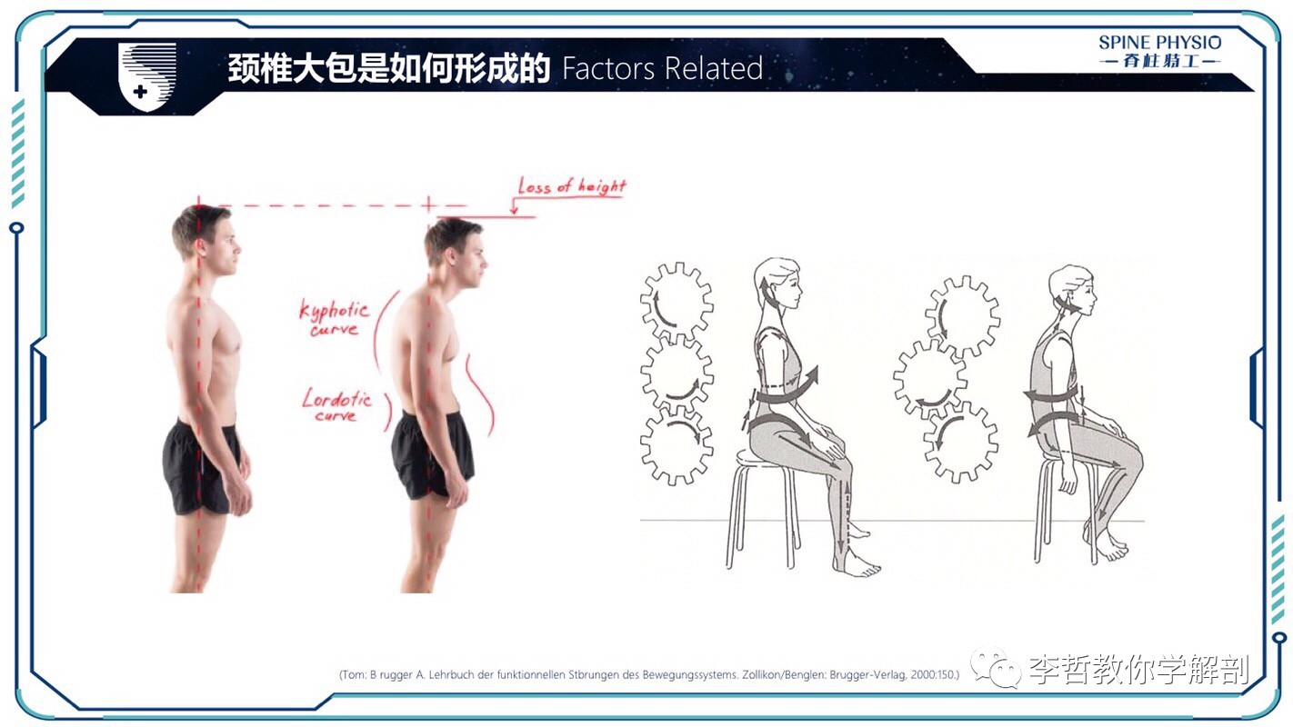 24度颈部大包怎么去除,颈后大包通过训练消除