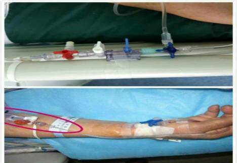 「护理宣教」小小穿刺针，实时报血压