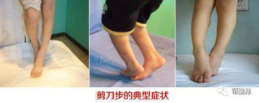 脑瘫剪刀步哪些动作可以改善,脑瘫剪刀步态康复训练