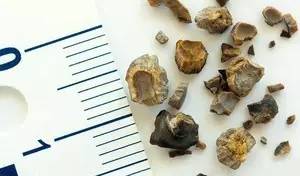 尿路结石，藏在人体的“定时*弹炸**”！郝大夫与您聊聊防与治