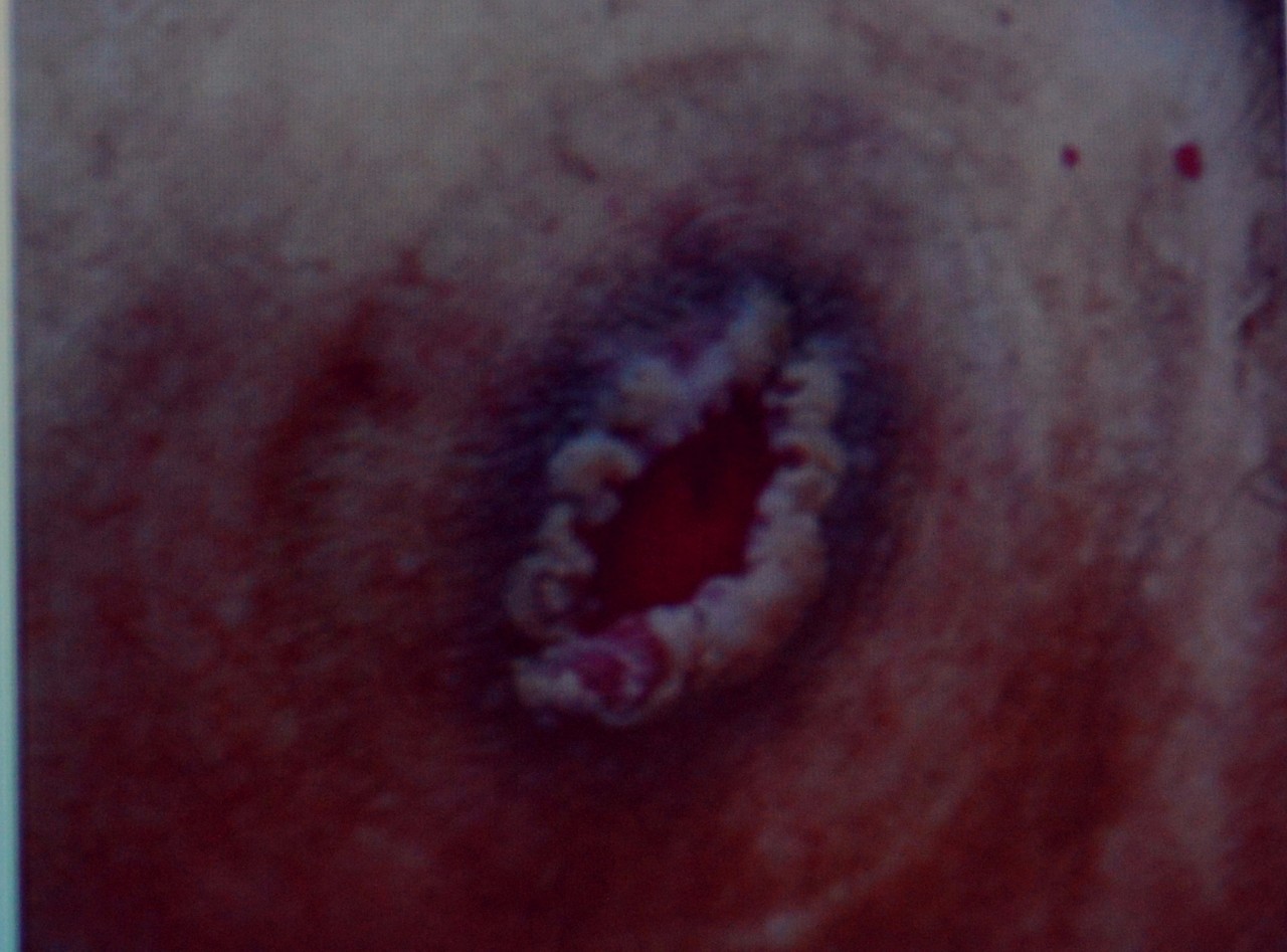 肠造口并发症最新护理文献,肠造口手术的并发症