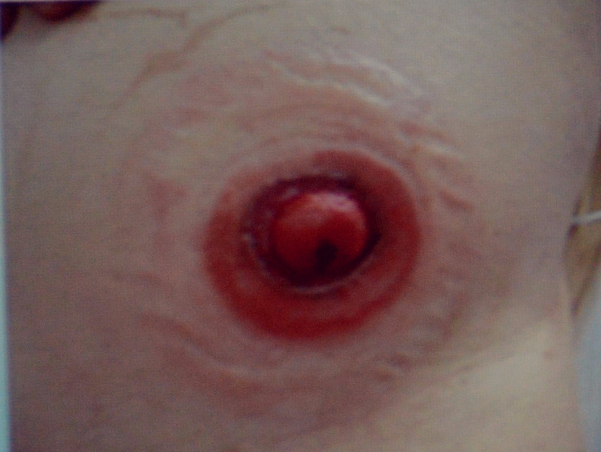 肠造口回纳的并发症是什么,膀胱全切肠造口有什么并发症