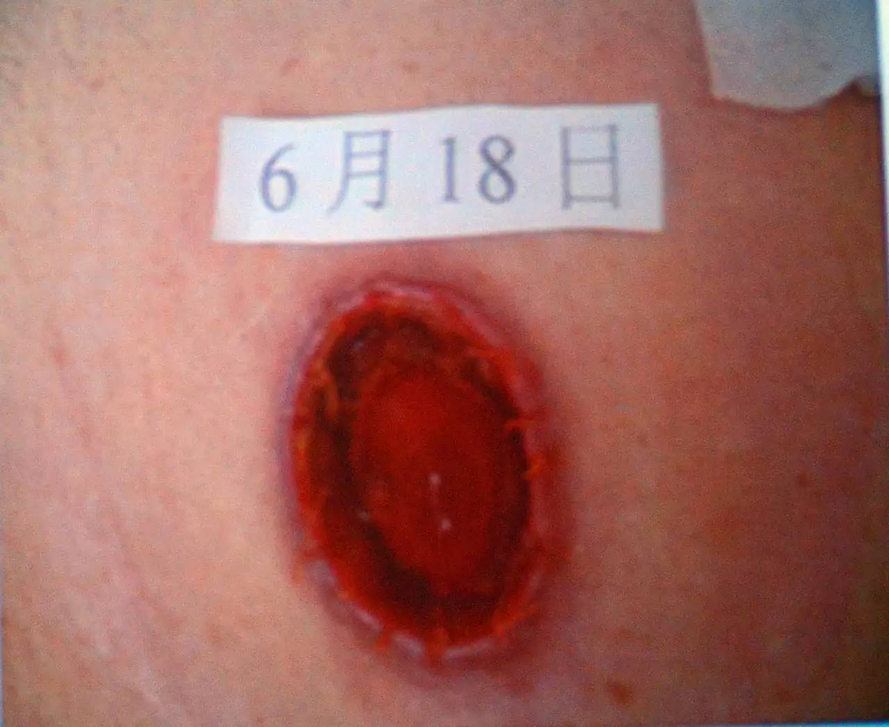 肠造口常见周围皮肤并发症,肠造口护理操作并发症