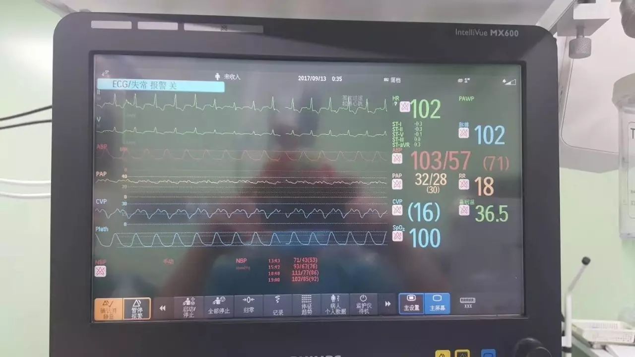 腰椎间盘突出微创案例,20年前的腰椎间盘微创手术