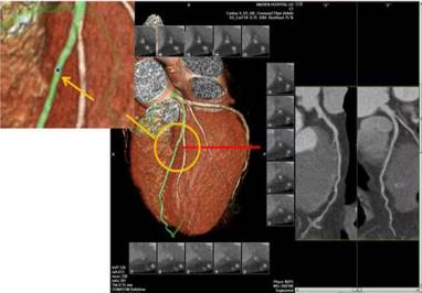 冠脉ct各个血管解读,冠脉CTA讲解