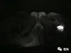 髋部疼痛做什么检查,左髋部疼痛待查病例