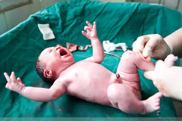 剖腹产全景记录,剖腹产恢复不同时期的照片