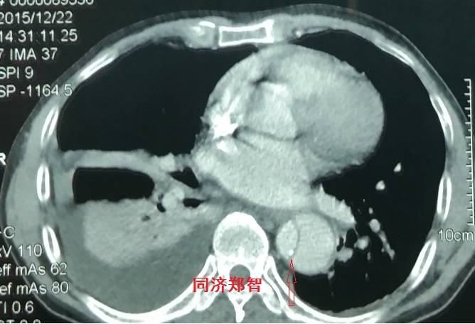 急性主动脉夹层cta影像诊断与鉴别,冠状动脉cta可以看到主动脉夹层吗