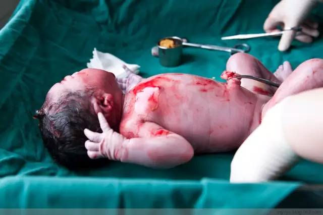 剖腹产全景记录,剖腹产恢复不同时期的照片