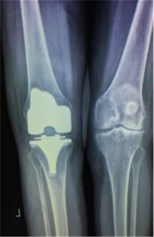 湘雅医院膝关节置换手术案例,赣州膝关节置换手术