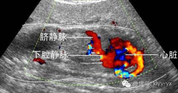 检查b超结果显示宫内早孕,检查b超还是阴超好