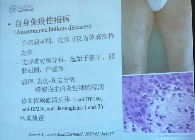 幼儿麻疹的鉴别方法,儿童麻疹的诊断与治疗