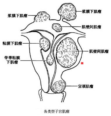 女性患上三大瘤罪魁祸首竟是内分泌失调专栏